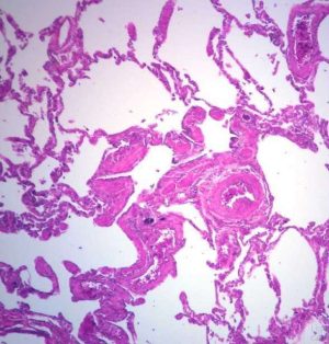 MELANOMA METASTÁSICO HUMANO A PULMÓN, PORTAOBJETOS DE MICROSCOPIO H&E DE 7 ?M #317768 CAROL. BIOL.