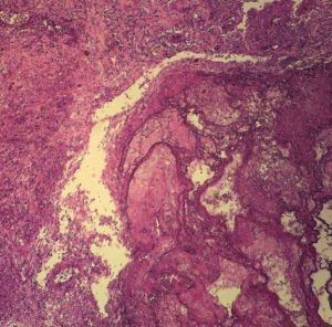 CARCINOMA METASTÁSICO HUMANO A PULMÓN. #317774 CAROLINA BIOLOGICAL